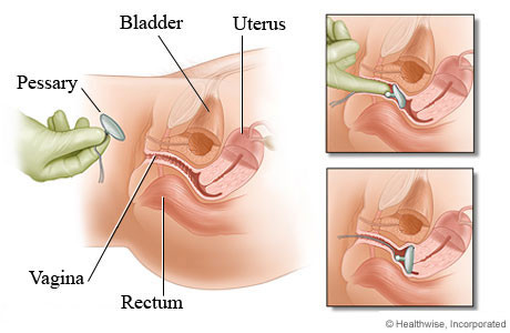Vaginal route