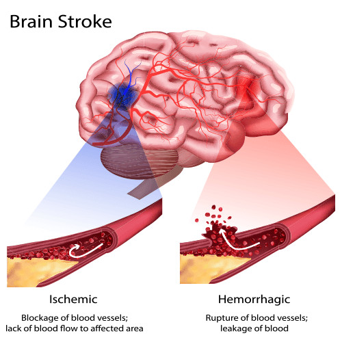 Stroke