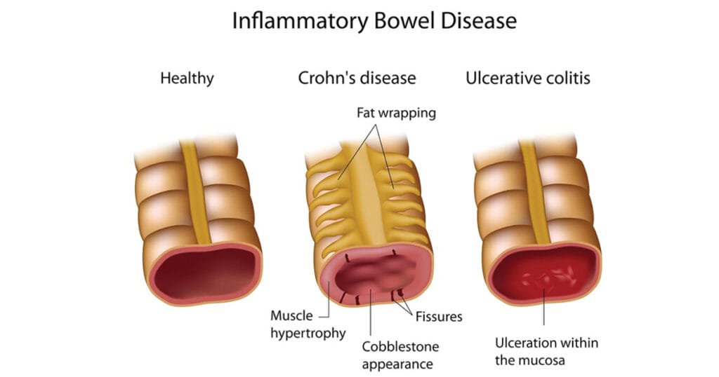 Inflammatory Bowel Diseases