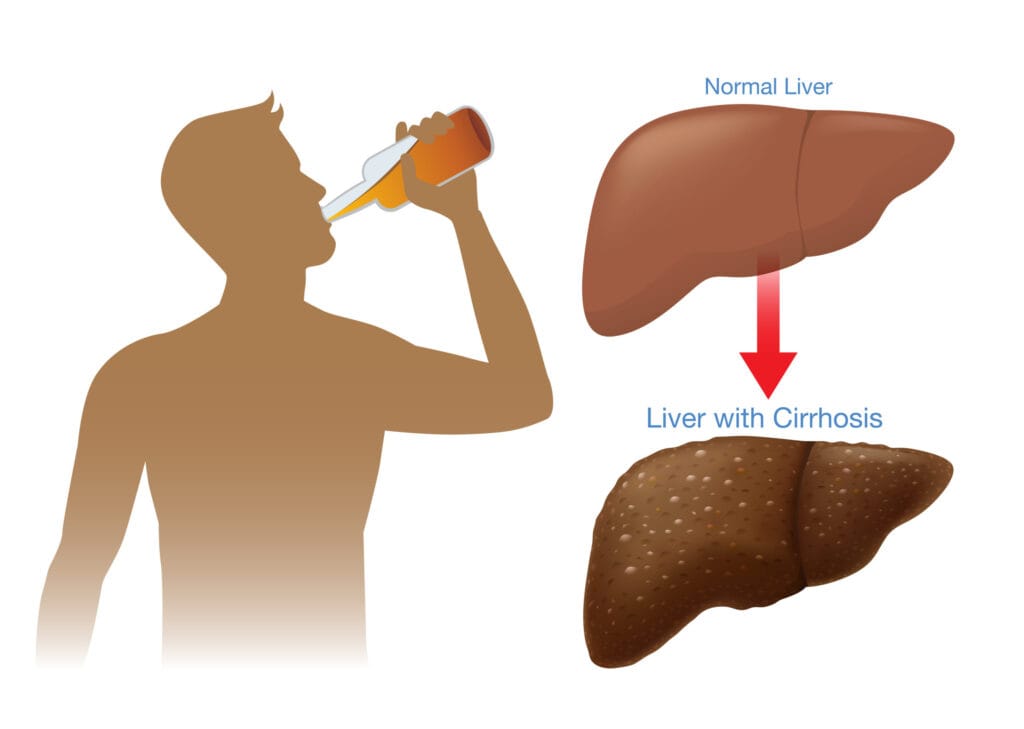 Alcoholic Liver Disease