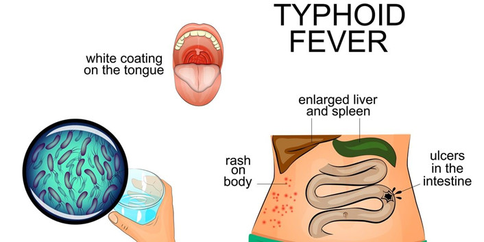 Typhoid Fever