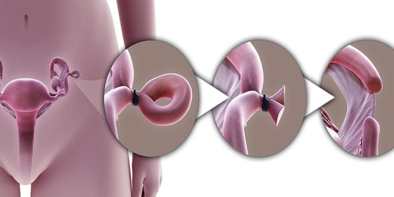 image 5 1 Contraceptive Devices